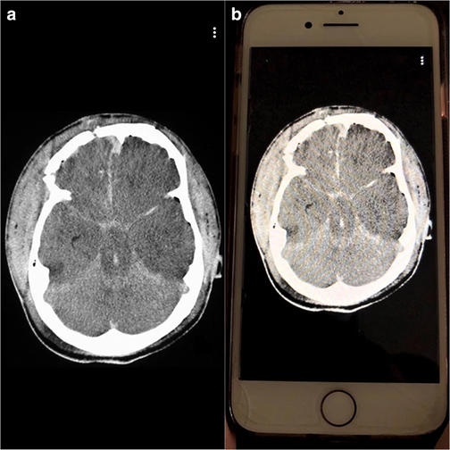 radiology image and on image on smartphone